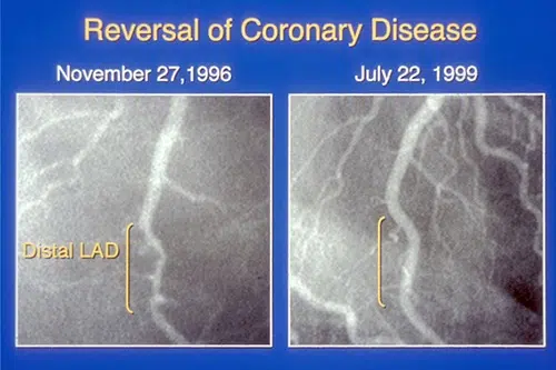 Reversal of Coronary Disease